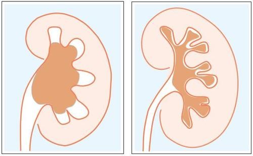结石都快长满肾脏了，身体却没感觉！医生：不痛的结石也会致命！
