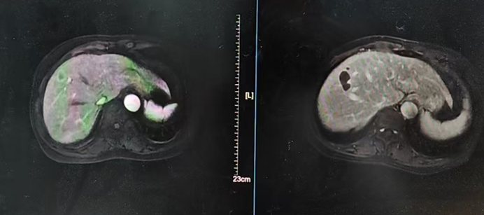 三药联合化疗+中医辅助，为晚期肠癌患者带来新希望！