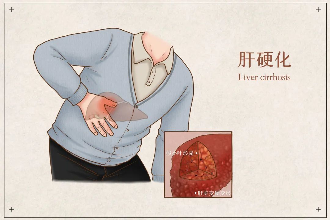 肝硬化了，还能“变软”吗？可以吃这4种食物！