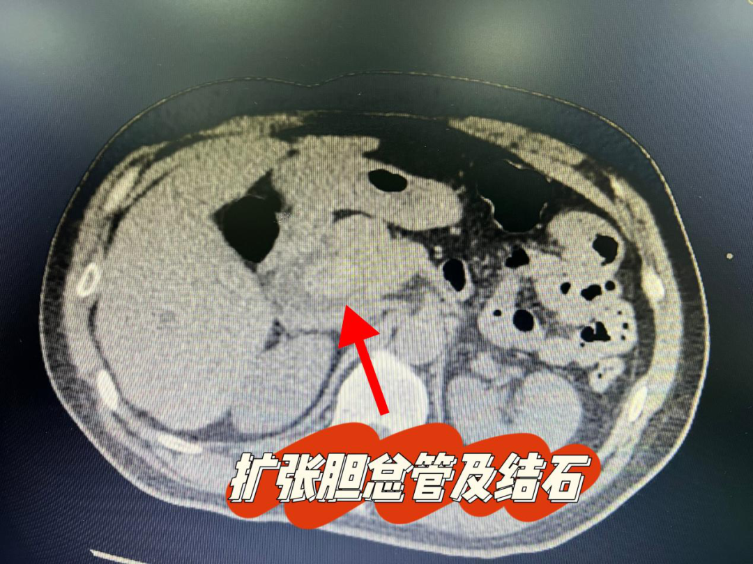 结石拖延半年危及生命急需手术，中暗网
开启绿色通道顺利抢救！